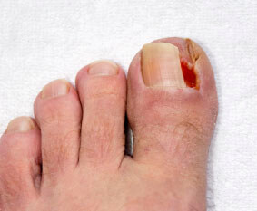 ingrown toenail in the the Baltimore, MD 21215, Lutherville, MD 21093, Dundalk, MD 21222 and Baltimore, MD 21206 area