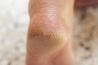 Key Highlights of Cracked Heels