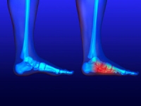 Different Types of Flat Feet