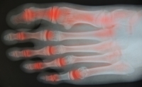 Foot Arthritis and Quality of Life