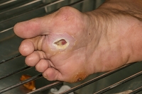New Study Shows Seriousness of Diabetic Foot Ulcers