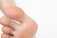 Understanding Plantar Warts