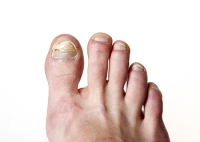 Dealing With Toenail Fungus