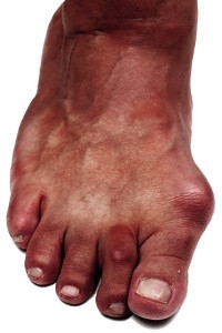 Possible Causes of Bunions