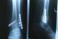 External Fixation for Ankle Fractures