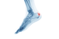 Causes and Relief Tactics for Heel Spurs