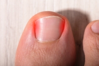 Surgery May Be Necessary for Permanent Relief From an Ingrown Toenail